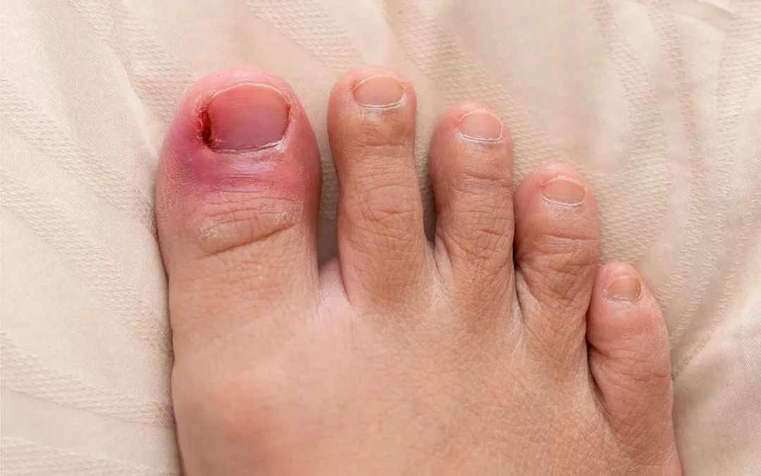 Ingrown Toenail Infections: Causes and How to Prevent Them