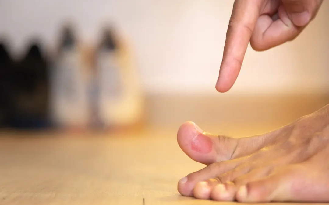 What Causes Blisters on Your Feet? A Complete Breakdown