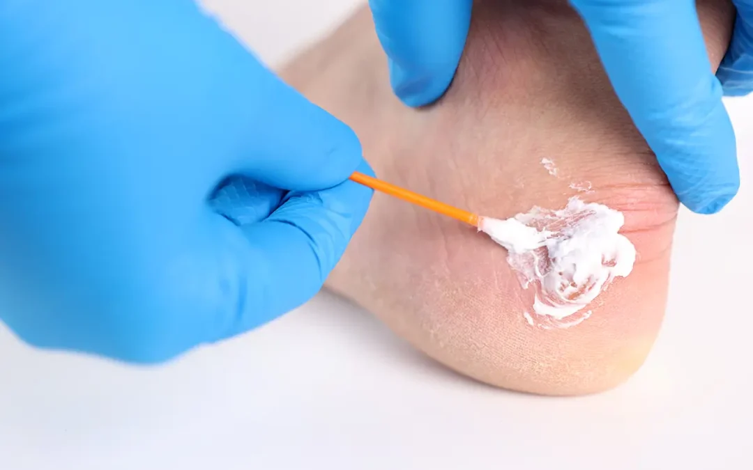 How to Identify and Treat Corns on Your Feet Effectively