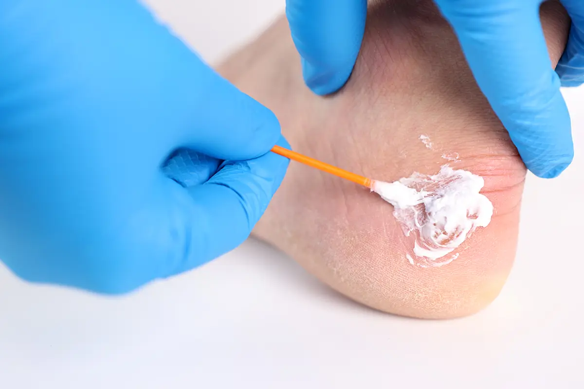 the doctor treats corns on the feet by applying an ointment the doctor treats corns on the feet by applying an ointment