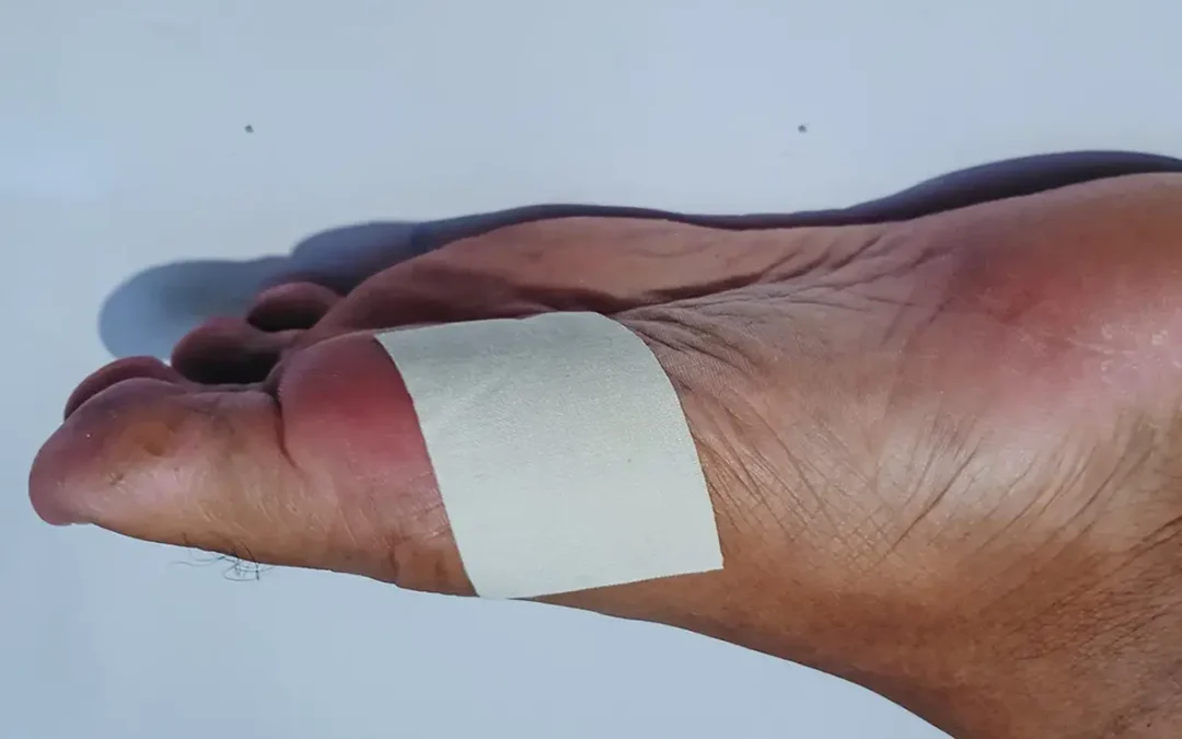 A Step-by-Step Guide to Caring for Foot Wounds