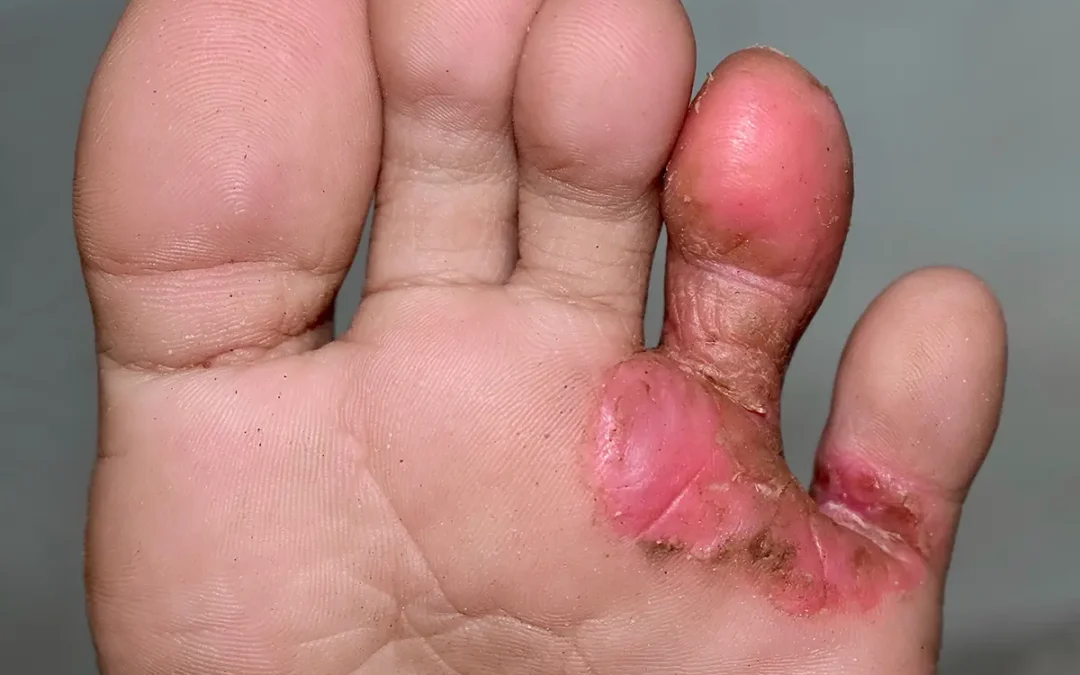 Contagious Athlete’s Foot: How to Prevent Spreading and Recurrence