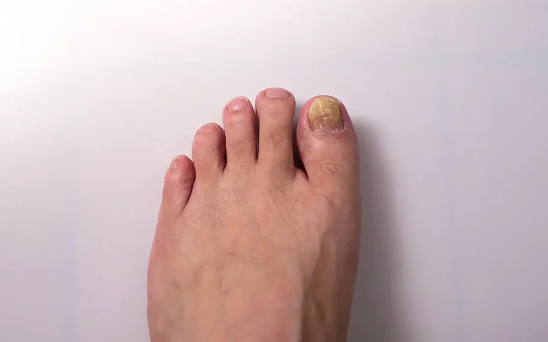 Contagious Toenail Fungus: What You Need To Know