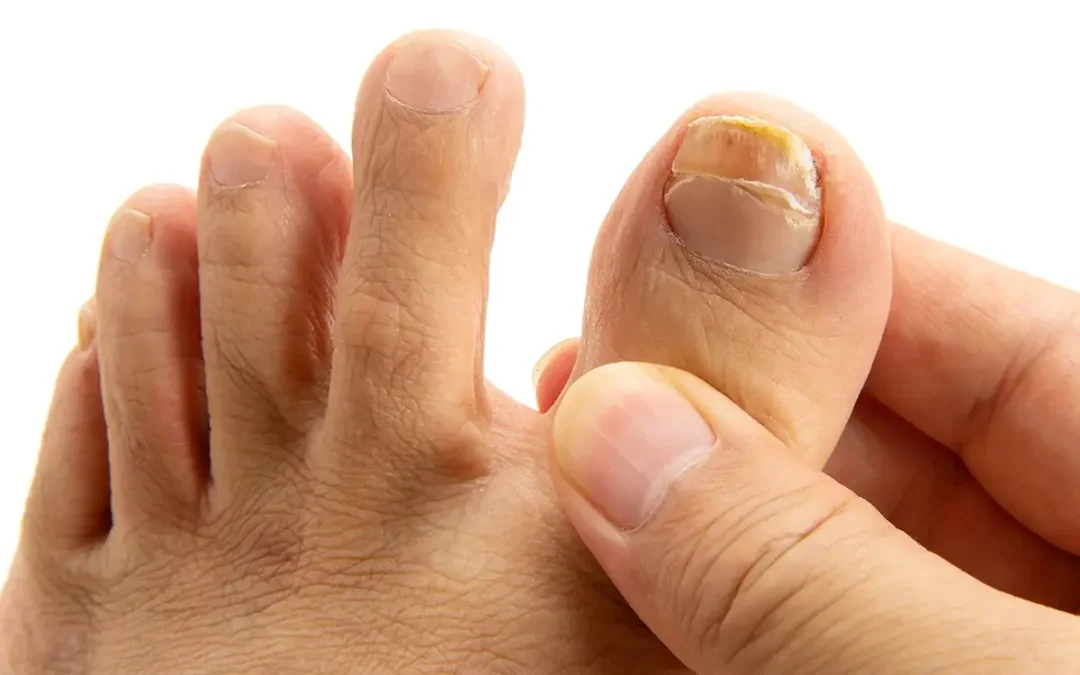 Toenail Fungus