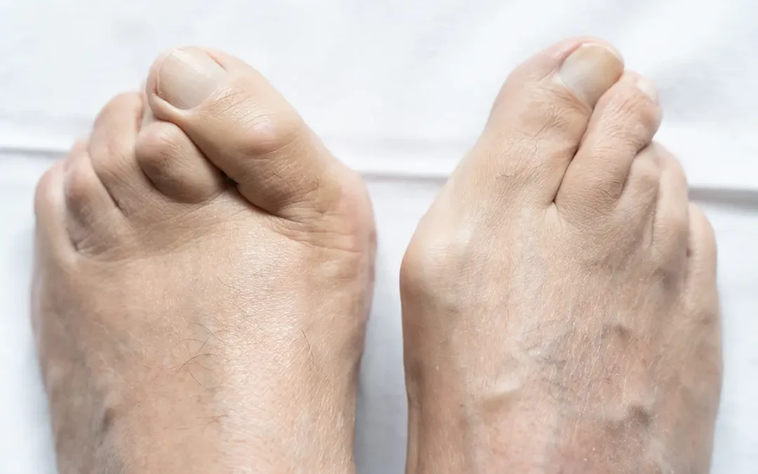 Hammertoe: Symptoms, Causes, and Treatment Options