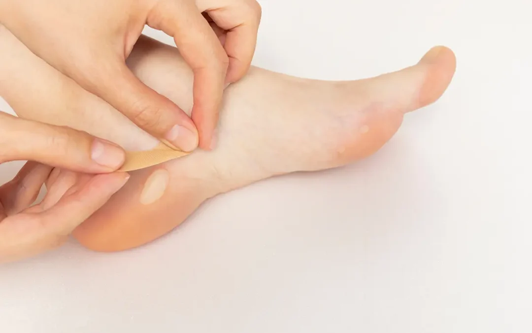 Blisters on the Feet: Causes, Prevention, and Care