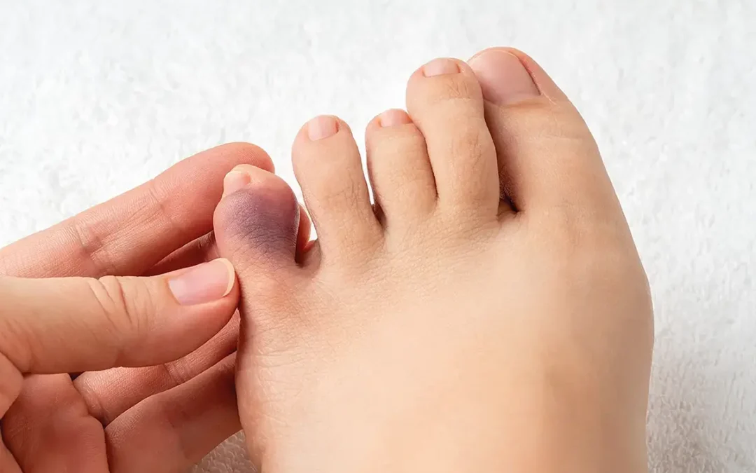 Could My Stubbed Toe Be Broken?