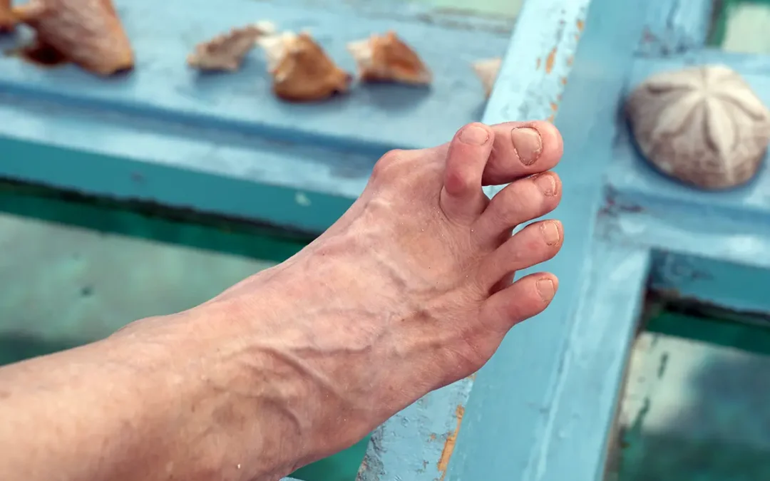 What Is Hammertoe? Understanding the Deformity