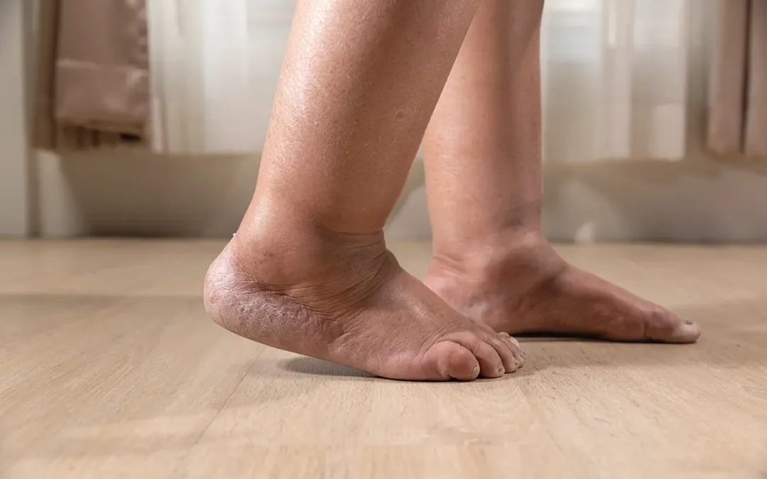 Different Types of Edema and How They Affect Your Feet