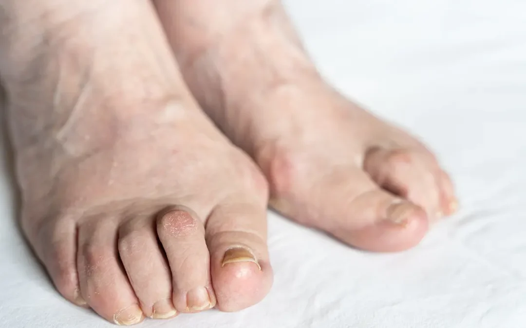 Hammertoe Is a Common Deformity